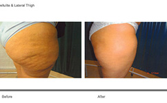 Cellulite & Lateral Thigh